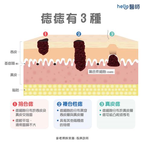 黑痣的形成|痣形成的原因？痣長毛、痣變多變大是痣病變？5招判。